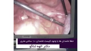 لاپاراسکوپی کیست تخمدان بزرگ