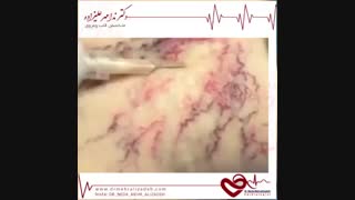 اسکلروتراپی روش درمان واریس