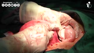 جراحی میومکتومی