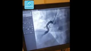 آنژیوپلاستی بیمار با سکته قلبی حاد