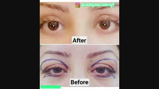 نمونه های از عمل بلفاروپلاستی
