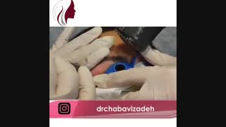 فیلم واقعی لیزر رفع جای زخم بلفاروپلاستی از نزدیک