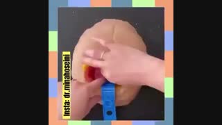 زایمان سزارین