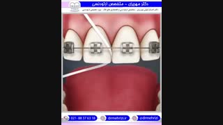 استفاده از نخ دندان به ویژه در افرادی که دندانهایشان را ارتودنسی کردهاند | دکتر احسان مهریزی
