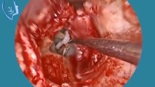 فیلم وبینار اموزشی جراحی اندوسکوپی گوش