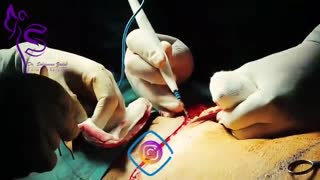 فیلم واقعی جراحی همزمان لیفت و لیپوماتیک شکم و پهلو