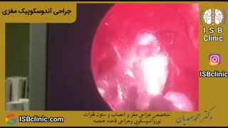 آندوسکوپیک مغزی