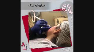 فیلم واقعی میکرونیدلینگ صورت
