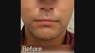 فیلم واقعی زاویه دار کردن صورت با تزریق فیلر فک