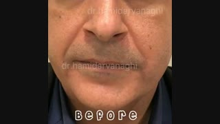 معجزه هایفوتراپی را ببینید