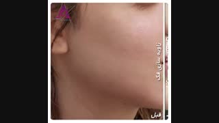 زاویه سازی فک با هیالورونیک اسید