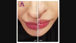 فیلم واقعی فیلر چانه مدل مثلثی