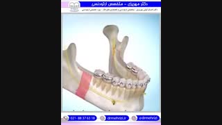 درمان ارتودنسی و جراحی جلو بودن فک پایین | دکتر احسان مهریزی
