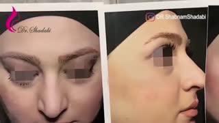 ّفیلم بلافاصله بعد جراحی بینی گوشتی