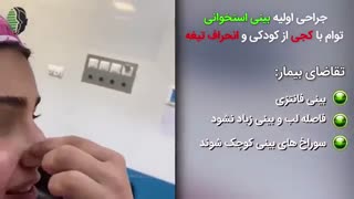 جراحی اولیه بینی استخوانی توام با کجی و انحراف تیغه | دکتر باستانی نژاد