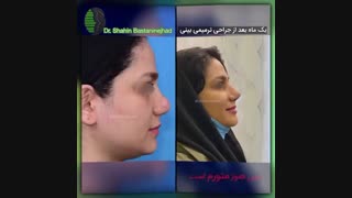 جراحی ترمیمی سوم بینی | دکتر باستانی نژاد | جراح بینی ترمیمی