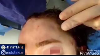 لیفت آندوسکوپیک ابرو و پیشانی با اندوتاین | پروفسور کشکولی | جراح پلک تهران