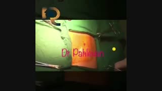 بازسازی نقص فک فوقانی در بیمار مبتلا به شکاف مادرزادی لب و کام یک طرفه