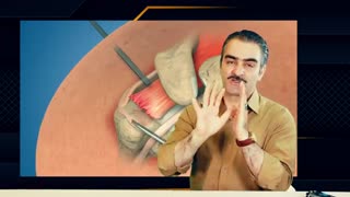 جراحی روتاتور کاف  شانه