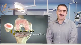 تعویض مفصل زانو