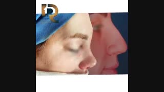 نمونه جراحی بینی گوشتی