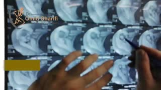 ارتروسکوپی شانه