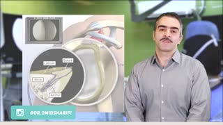 شکستگی مفصل شانه