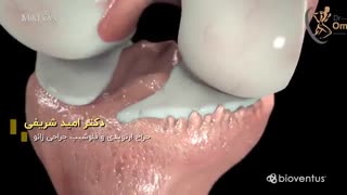 آرتروز زانو