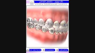 انیمیشن نحوه استفاده صحیح از مسواک در طول درمان ارتودنسی | دکتر احسان مهریزی