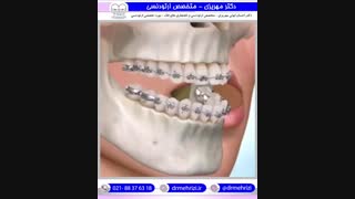 درمان ارتودنسی و جراحی عقب بودن فک بالا | دکتر احسان مهریزی