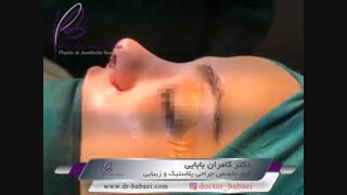 فیلم برداشتن آتل بینی