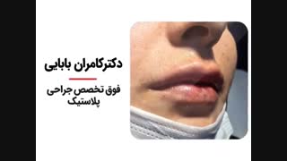فیلم واقعی تزریق ژل به لب درمان جای جوش