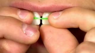 بستن فاصله بین دندانها به هر روشی هرگز | دکتر سعید قریشی