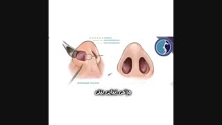 انیمیشنی از جراحی رینوپلاستی