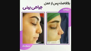 جراحی بینی
