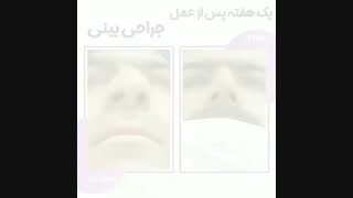 یک هفته پس از جراحی بینی