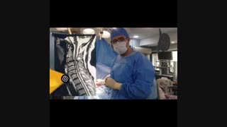 فیلم واقعی عمل جراحی تنگی کانال نخاعی گردن