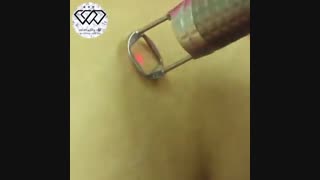 فیلم واقعی درمان استریا با لیزر فوتونا (ترک های ناشی از چاقی و لاغری مکرر)