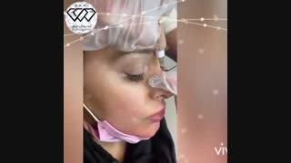 فیلم واقعی فرم‌دهی بینی بدون جراحی و با تزریق ژل