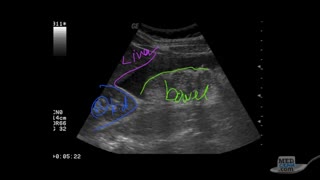 Hemoperitoneum / Free Fluid in the RUQ on Ultrasound - FAST Exam