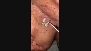 برداشتن زگیل تناسلی با روش فریز کردن