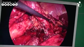 نفرکتومی لاپاراسکوپی‌ کلیه