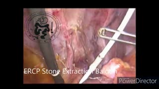 اکسپلور (بررسی) مجرای صفرا (کلدوک) از نظر سنگ مجرای صفرا وکلدوکوسکوپی حین عمل