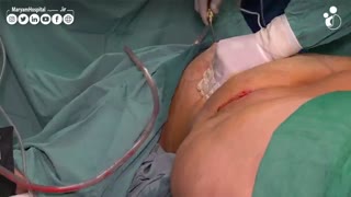 ابدومینو پلاستی