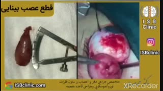 قطع عصب بینایی