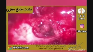 نشت مایع مغز