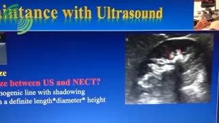 فیلم واقعی اختلاف سایز سنگ کلیه در سونوگرافی و سی تی اسکن