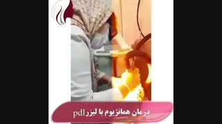 فیلم درمان همانژیوم با لیزر Pdl