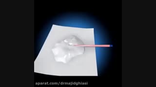 درمان روت کانال