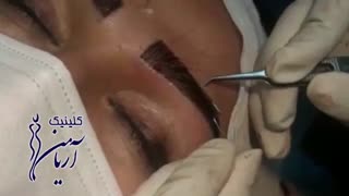 کاشت ابرو  در کلینیک آریامن